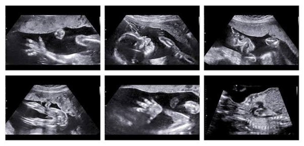 Anomaly / Detail Scan - Between 20 - 24 Weeks (Twins)